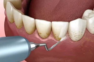 teeth scaling vs cleaning